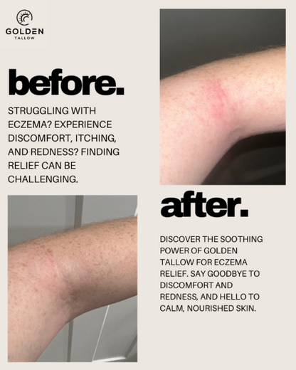 Before and after comparison of eczema relief with Golden Tallow, showing skin with redness on one side and smoother skin on the other.